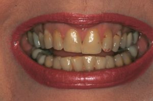 Teeth with overbite and TMJ pain.