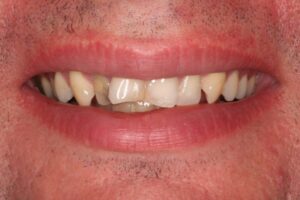 Smile Makeover – Case 1