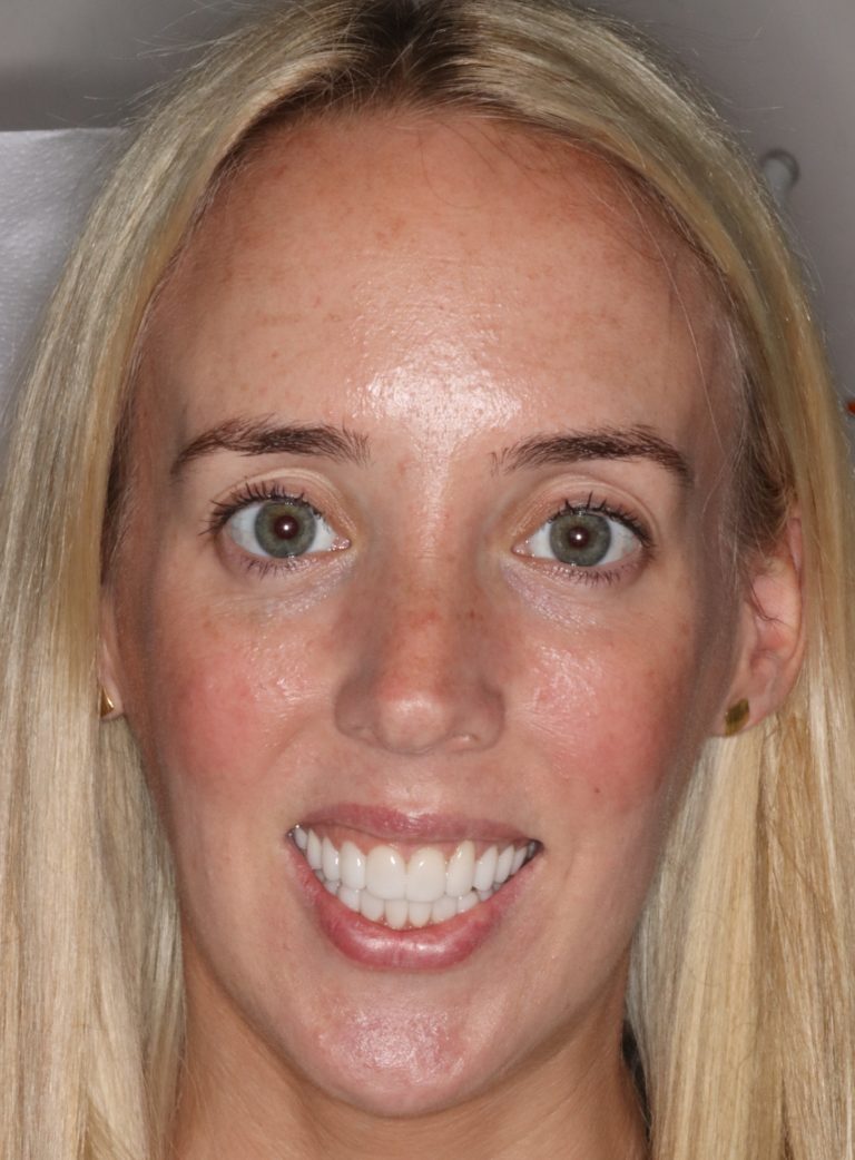 After Image: Can Veneers be used to Change a Narrow Smile? - front