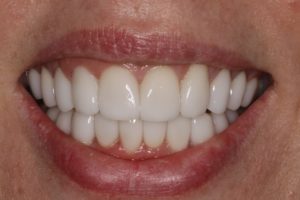 Can Veneers be used to Change a Narrow Smile?
