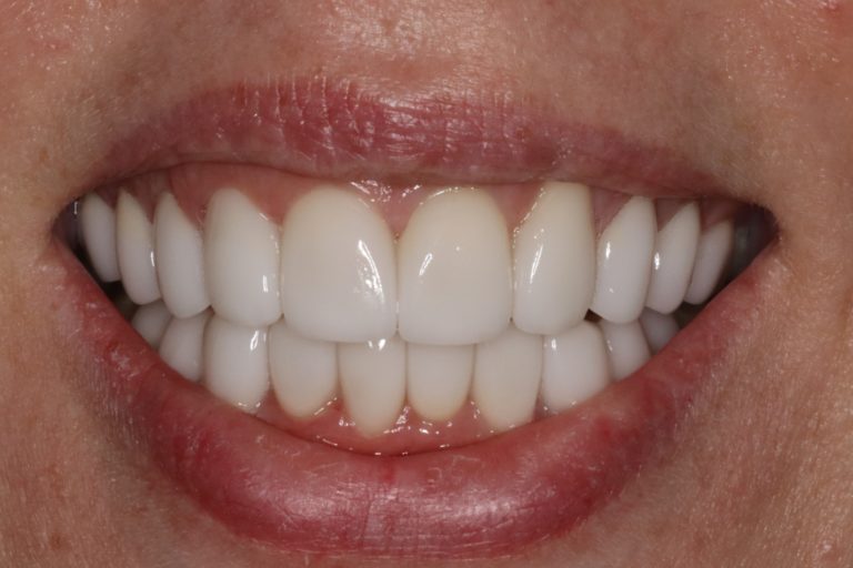 After Image: Can Veneers be used to Change a Narrow Smile? - front