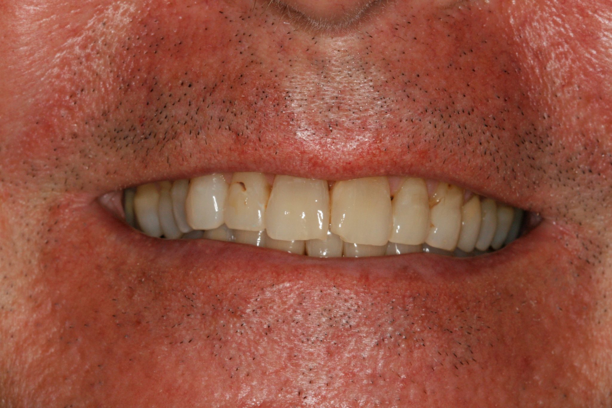 Stained and Chipped Teeth: Smile Makeover to Reverse Aging Teeth
