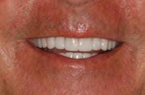 Stained and Chipped Teeth: Smile Makeover to Reverse Aging Teeth