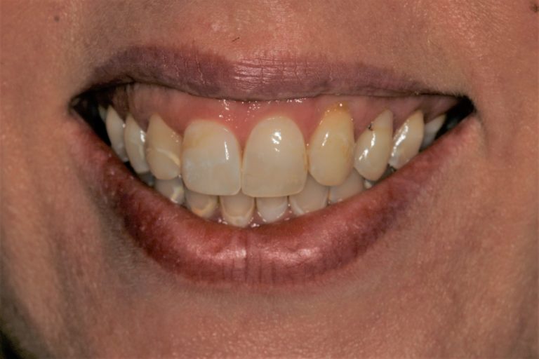 Before Image: Can Veneers be used to Change a Narrow Smile? - front