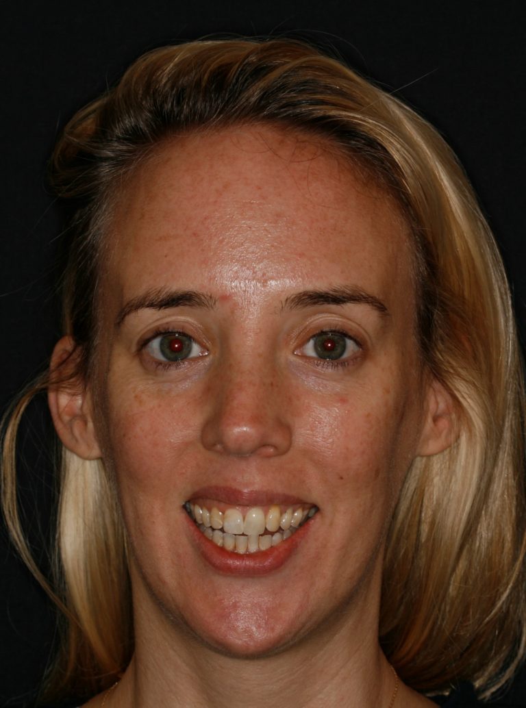 Before Image: Can Veneers be used to Change a Narrow Smile? - front