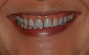 Gum Lift and Porcelain Veneers Combined with a Dental Implant
