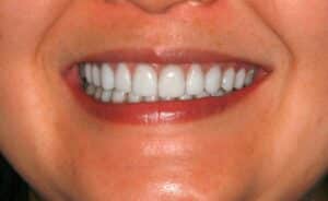 Gum Lift and Porcelain Veneers Combined with a Dental Implant