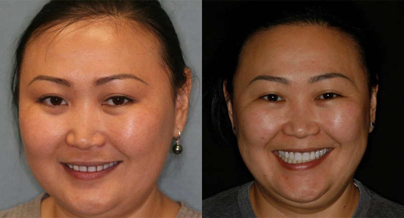 Expert Gum Contouring Services in Texas