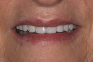 Porcelain Veneers