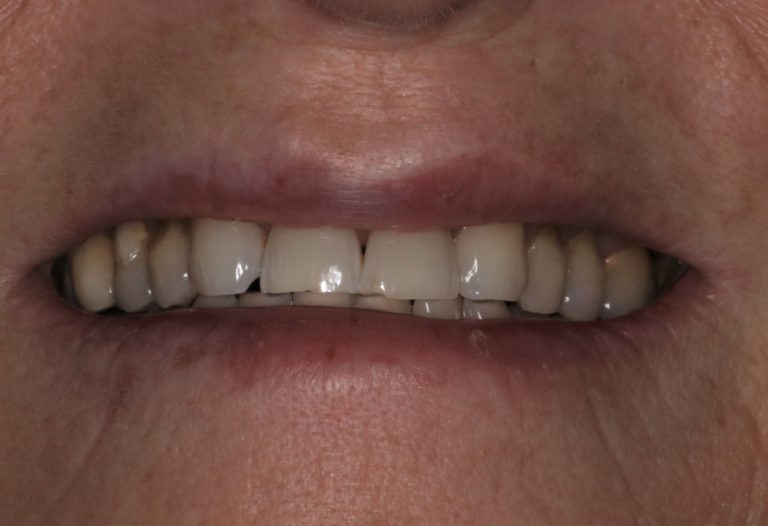 Before Image: Porcelain Veneers to Correct Worn and Aged Teeth - front