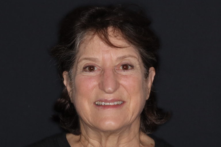 Before Image: Porcelain Veneers to Correct Worn and Aged Teeth - front
