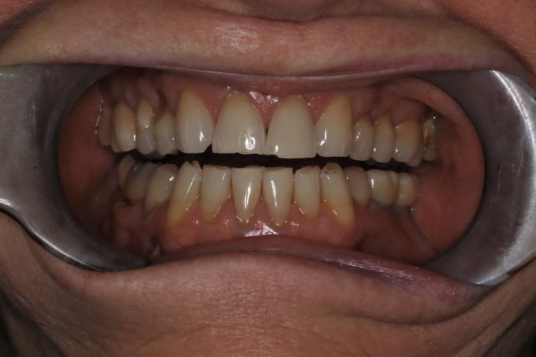 Before Image: Porcelain Veneers to Correct Worn and Aged Teeth - front
