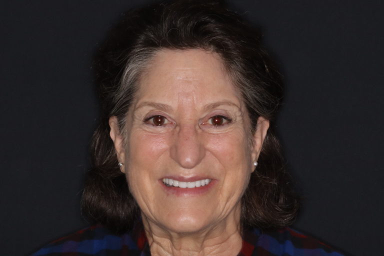 After Image: Porcelain Veneers to Correct Worn and Aged Teeth - front