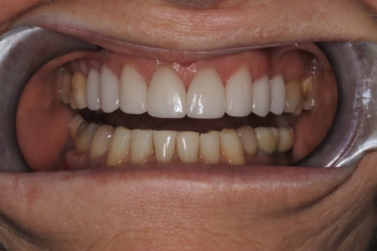 After Image: Porcelain Veneers to Correct Worn and Aged Teeth - front