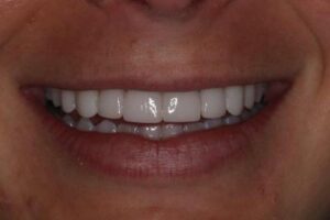 Veneers on side teeth that gives a beautiful smile.