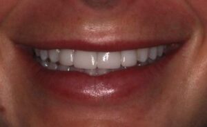 Narrow smile and un-proportional teeth