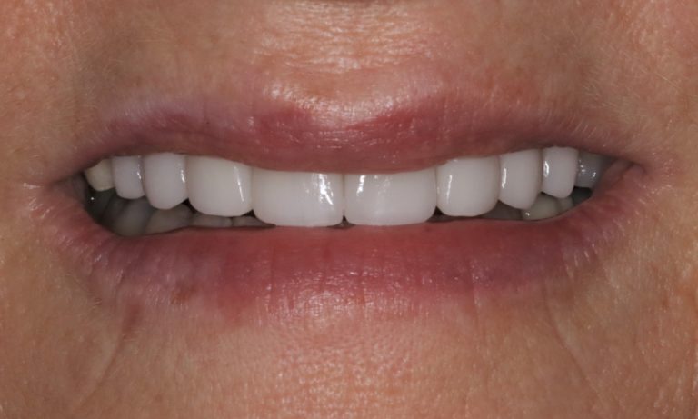 After Image: Porcelain Veneers to Correct Worn and Aged Teeth - front