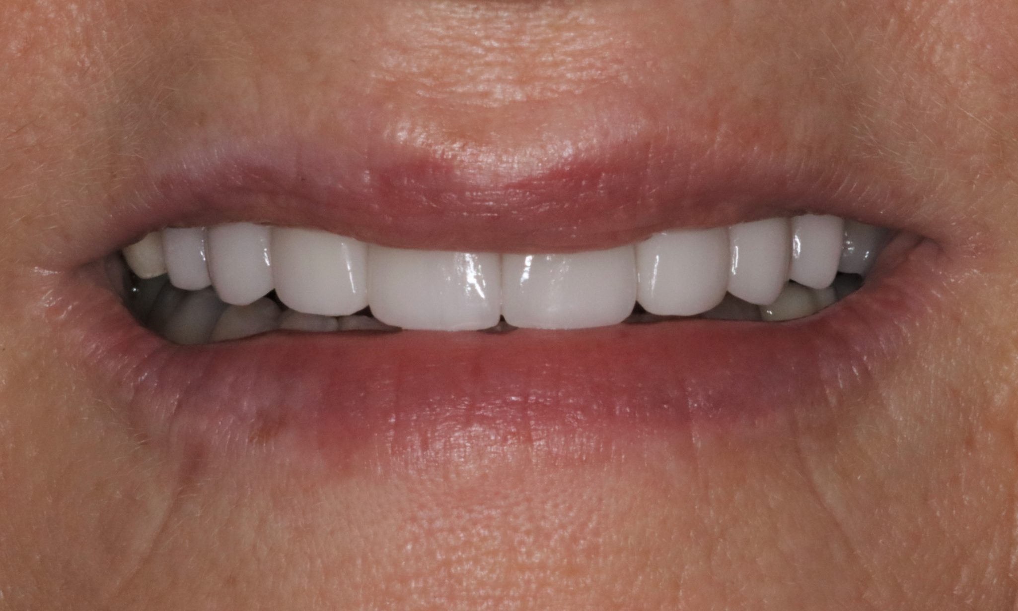Porcelain Veneers to Correct Worn and Aged Teeth