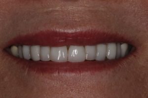 Before porcelain veneers Konig Center