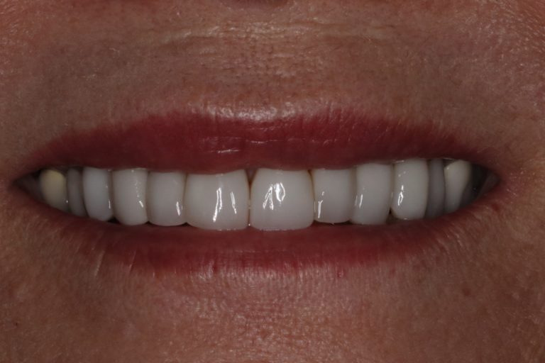 Before Image: Porcelain Veneers to Change the Size and Shape of the Face and Teeth - front