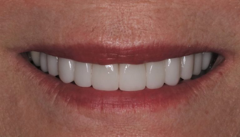 After Image: Porcelain Veneers to Change the Size and Shape of the Face and Teeth - front