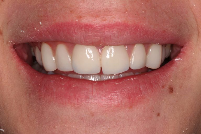 Before Image: Are All Veneers the Same? Or Is It a Artform? - front