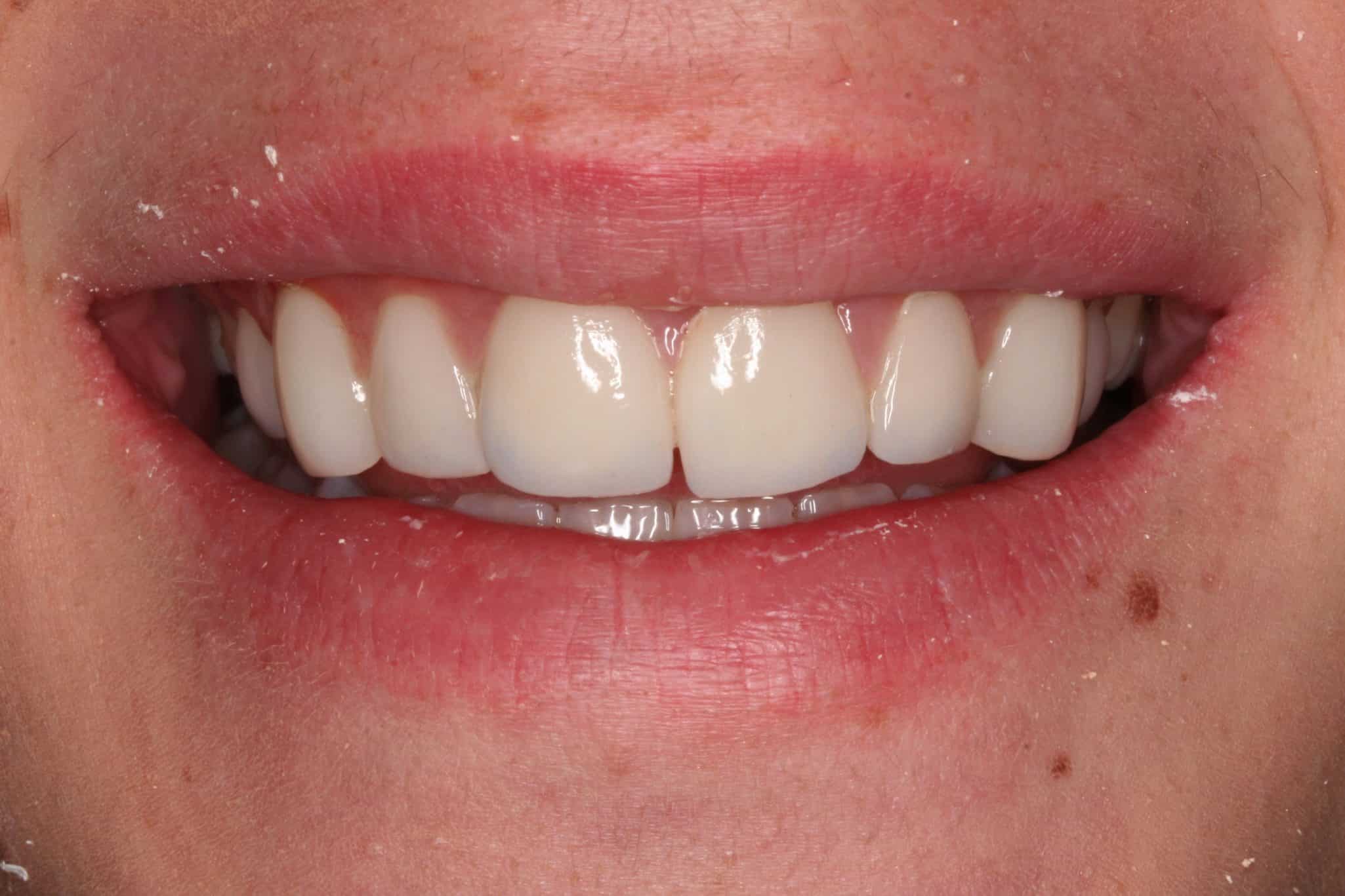 Before & After Porcelain Veneers to Correct Worn and Aged Teeth Case