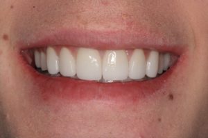 Are All Veneers the Same? Or Is It a Artform?