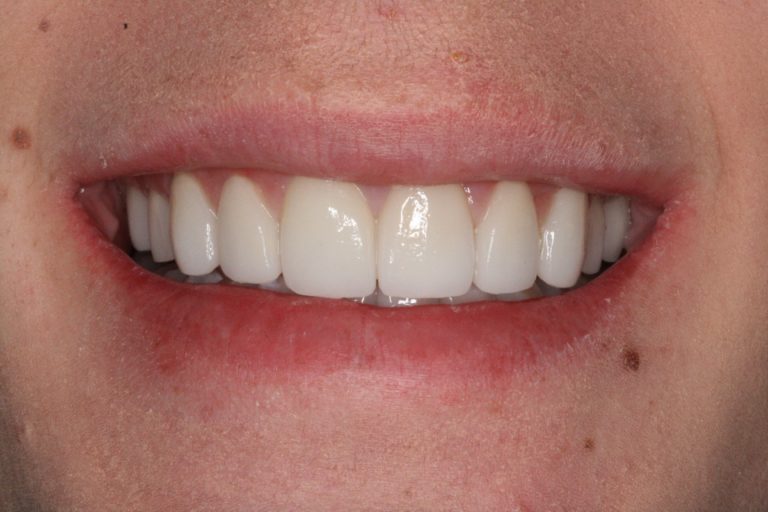 After Image: Are All Veneers the Same? Or Is It a Artform? - front