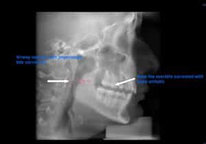 Airway and overbite correction