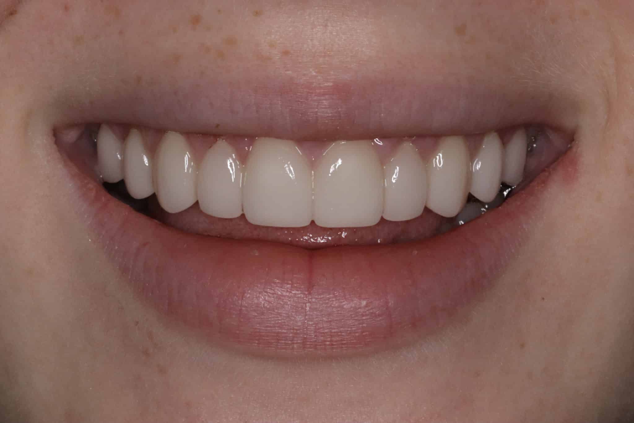 Custom Porcelain Veneers Konig Comprehensive Dentistry