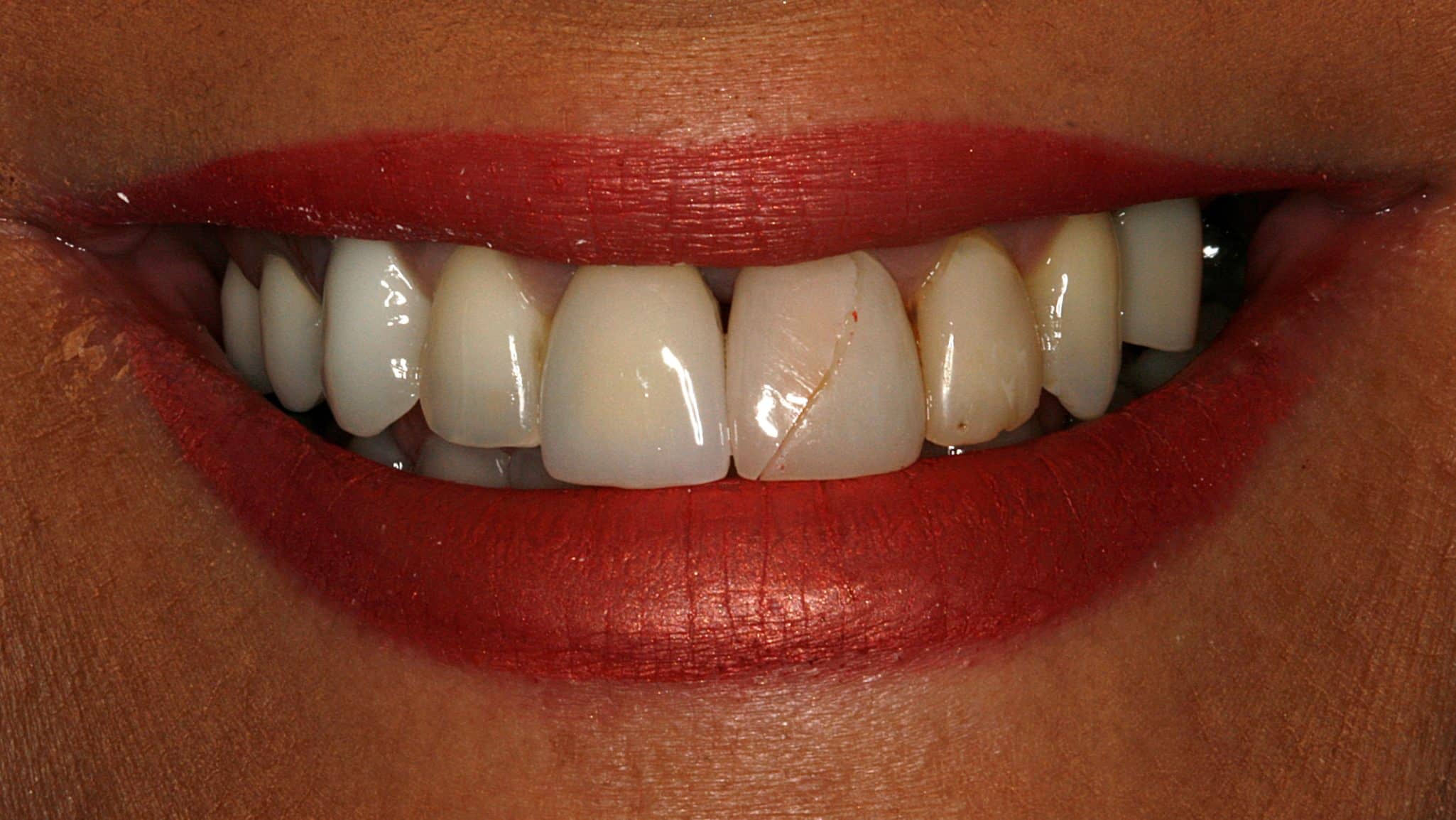 porcelain veneers before image konig center for cosmetic and comprehensive dentistry houston, tx