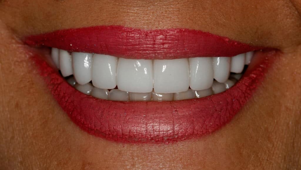 porcelain veneers after image konig center for cosmetic and comprehensive dentistry houston, tx