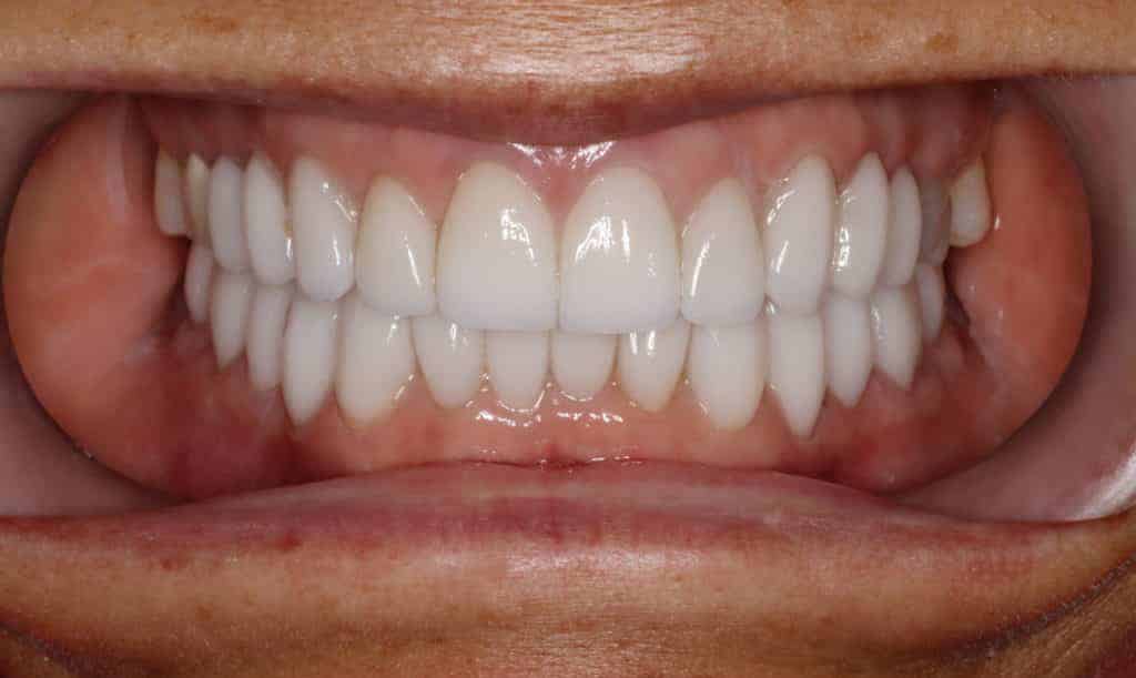 porcelain veneers case 3 after image konig center for cosmetic and comprehensive dentistry houston, tx