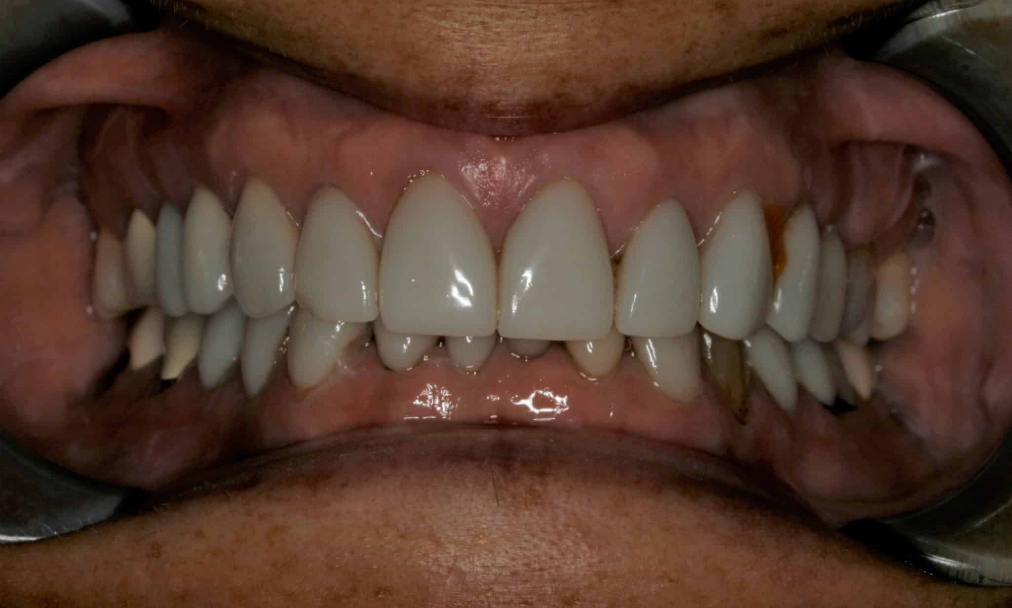 porcelain veneers case 3 before image konig center for cosmetic and comprehensive dentistry houston, tx