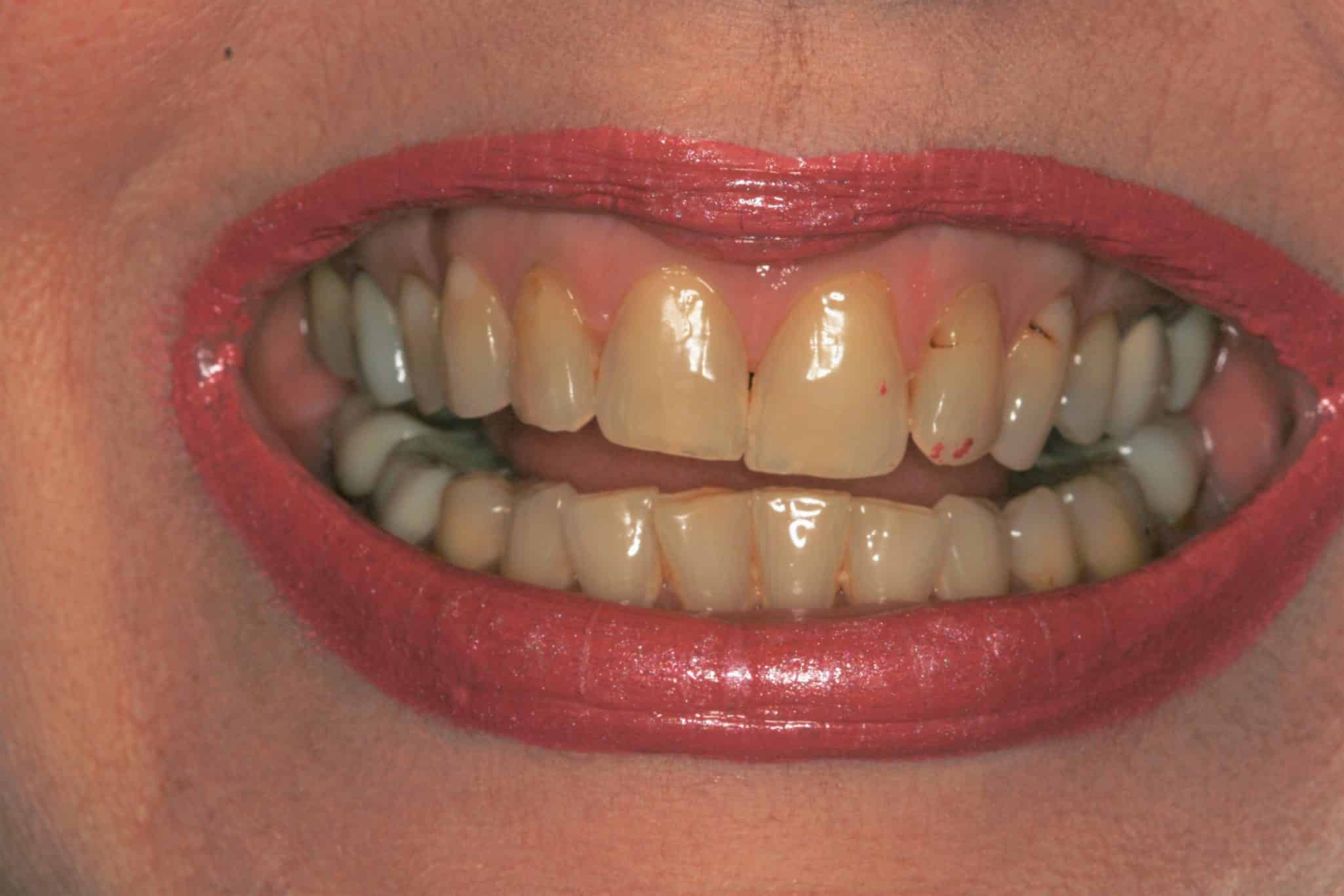 porcelain veneers case before image konig center for cosmetic and comprehensive dentistry houston, tx