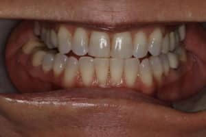 Custom Porcelain Veneers to Create a Natural and More Youthful Smile