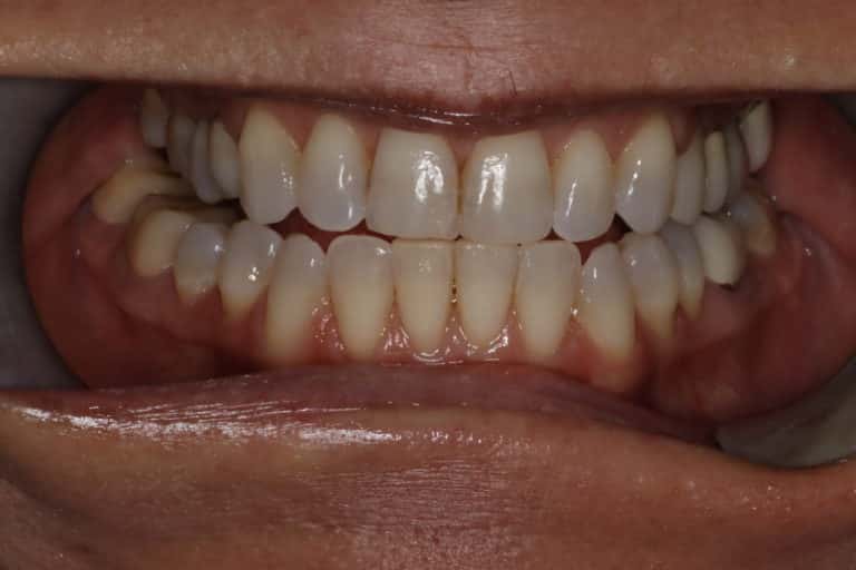 Before Image: Custom Porcelain Veneers to Create a Natural and More Youthful Smile - front