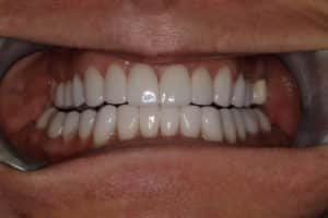 Custom Porcelain Veneers to Create a Natural and More Youthful Smile