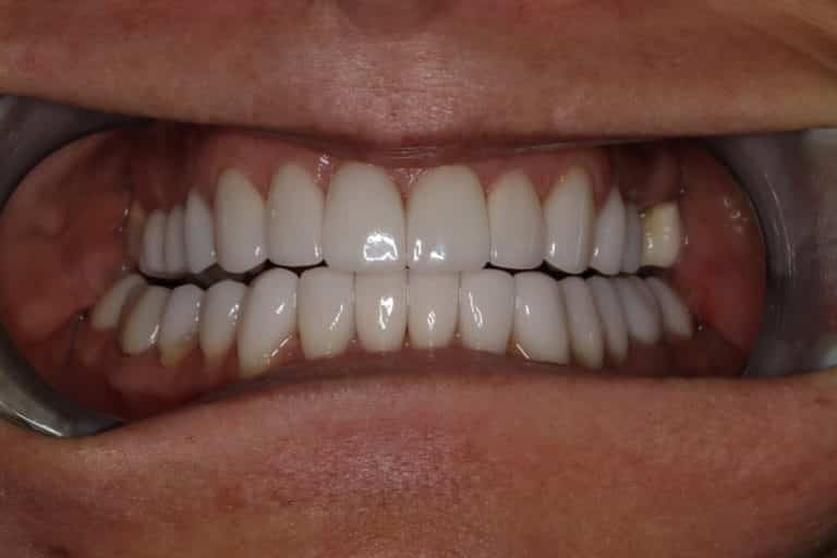 After Image: Custom Porcelain Veneers to Create a Natural and More Youthful Smile - front