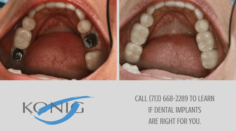 Implant Dentist in Houston