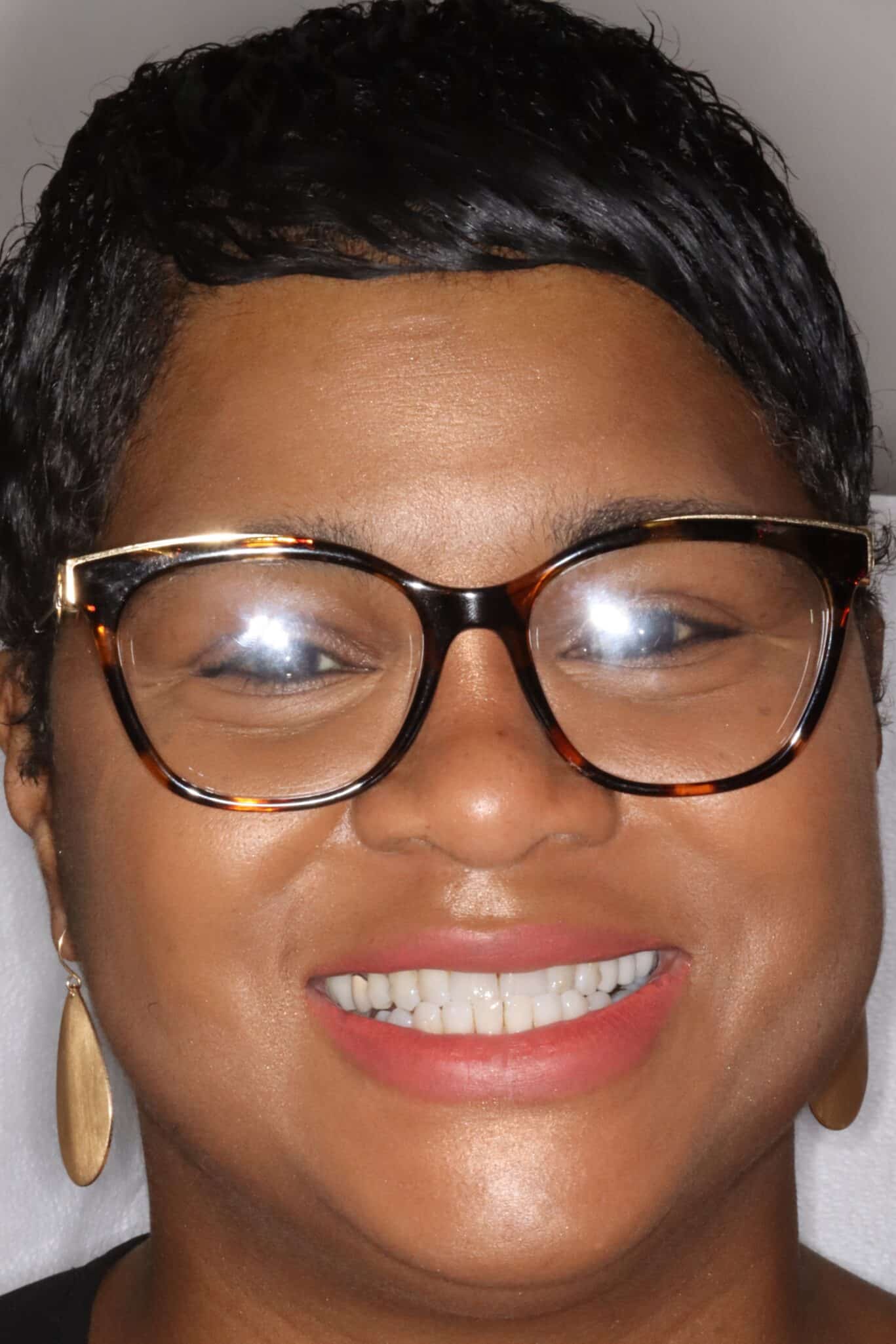 Can My Underbite and Facial Features Be Corrected NonSurgically