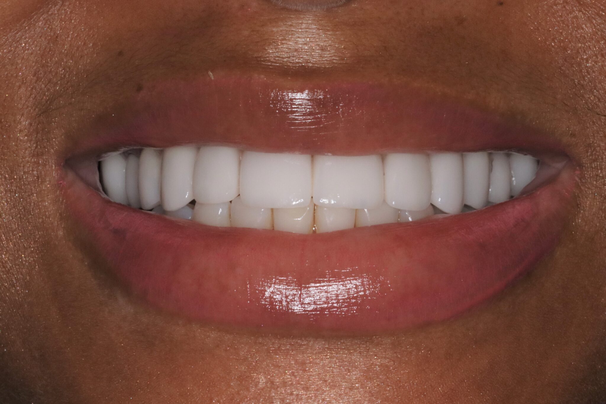 Can I Fix My Unattractive Underbite Without Surgery Konig Center for