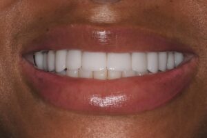 Can I Fix My Unattractive Underbite Without Surgery