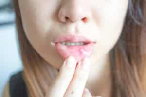 close up womans lip have a mouth ulcer.