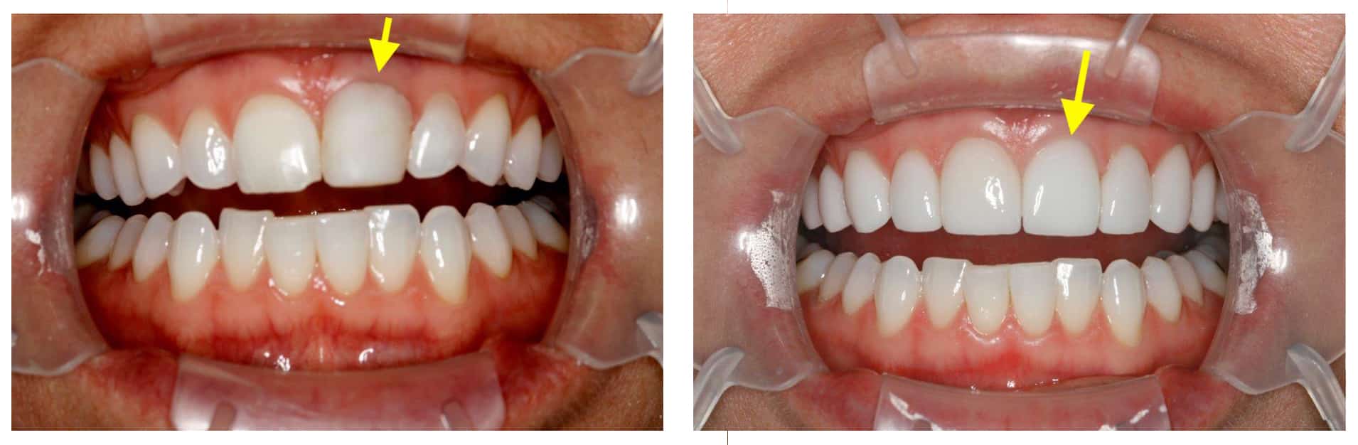 dr.konig b a implant and veneer