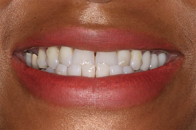 66214 underbite b1