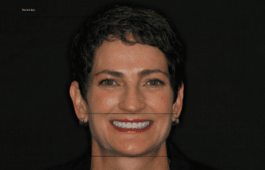 Overbite, Weak Chin, TMJ Pain