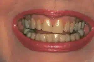 porcelain veneers 