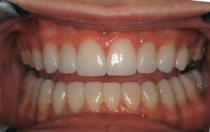 veneers